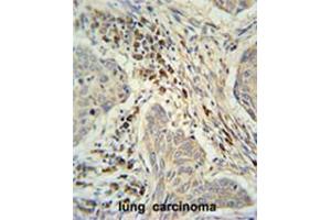 C19orf50 Antibody (Center) immunohistochemistry analysis in formalin fixed and paraffin embedded human lung carcinoma followed by peroxidase conjugation of the secondary antibody and DAB staining. (C19orf50 antibody  (Middle Region))