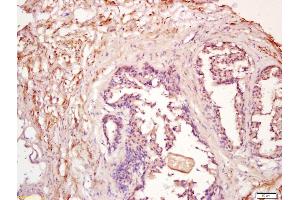 Formalin-fixed and paraffin embedded human prostate labeled with Anti-PDGF-D Polyclonal Antibody, Unconjugated (ABIN714581) at 1:200 followed by conjugation to the secondary antibody and DAB staining (PDGFD antibody  (AA 271-370))