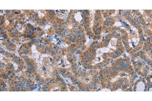 Immunohistochemistry of paraffin-embedded Human thyroid cancer using POMT1 Polyclonal Antibody at dilution of 1:50 (POMT1 antibody)