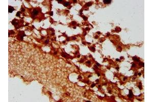 IHC image of ABIN7163270 diluted at 1:400 and staining in paraffin-embedded human melanoma performed on a Leica BondTM system.