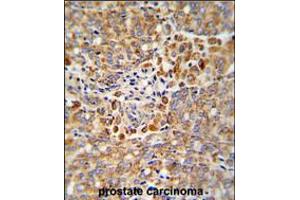 Formalin-fixed and paraffin-embedded human prostate carcinoma reacted with ALKBH3 Antibody , which was peroxidase-conjugated to the secondary antibody, followed by DAB staining. (ALKBH3 antibody  (C-Term))