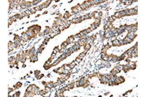 The image on the left is immunohistochemistry of paraffin-embedded Human esophagus cancer tissue using ABIN7191329(LTB4R2 Antibody) at dilution 1/20, on the right is treated with synthetic peptide. (LTB4R2 antibody)