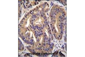 GTF2H2C Antibody (C-term) (ABIN655372 and ABIN2844928) immunohistochemistry analysis in formalin fixed and paraffin embedded human prostate carcinoma followed by peroxidase conjugation of the secondary antibody and DAB staining. (GTF2H2C antibody  (C-Term))