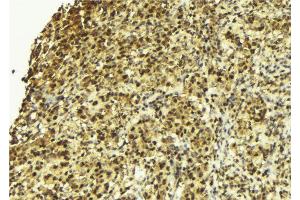 ABIN6273126 at 1/100 staining Human breast cancer tissue by IHC-P.