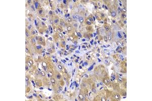 Immunohistochemistry of paraffin-embedded human liver damage using C antibody (ABIN6127549, ABIN6137937, ABIN6137938 and ABIN6223226) at dilution of 1:100 (40x lens). (CARD10 antibody  (AA 863-1032))