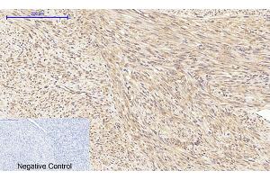 Immunohistochemical analysis of paraffin-embedded human uterus cancer tissue. (AKT1 antibody  (pThr308))