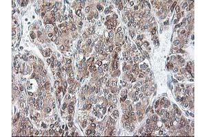 Immunohistochemical staining of paraffin-embedded Carcinoma of Human liver tissue using anti-RPN1 mouse monoclonal antibody.