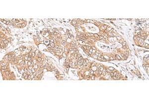 Immunohistochemistry of paraffin-embedded Human gastric cancer tissue using SEC11A Polyclonal Antibody at dilution of 1:45(x200) (SEC11A antibody)