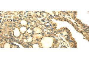 Immunohistochemistry of paraffin-embedded Human thyroid cancer using SDHA Polyclonal Antibody at dilution of 1/40 (SDHA antibody)