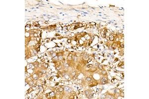 Immunohistochemistry of paraffin-embedded Human liver cancer using  antibody (ABIN7265531) at dilution of 400 (40x lens). (ALDH1A1 antibody)