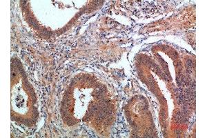 Immunohistochemical analysis of paraffin-embedded human-colon-cancer, antibody was diluted at 1:200 (PDGFC antibody  (AA 61-110))