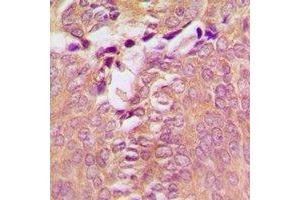 Immunohistochemical analysis of DAP Kinase 1 staining in human breast cancer formalin fixed paraffin embedded tissue section. (DAP Kinase 1 antibody)