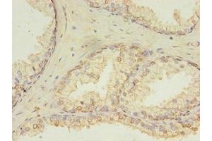 Immunohistochemistry of paraffin-embedded human prostate cancer using ABIN7154764 at dilution of 1:100
