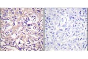 Immunohistochemistry analysis of paraffin-embedded human breast carcinoma tissue, using TK (Ab-13) Antibody. (TK (AA 1-50) antibody)
