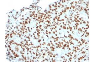 Formalin-fixed, paraffin-embedded human Breast Carcinoma stained with BMI1 Mouse Monoclonal Antibody (BMI1/2823). (BMI1 antibody  (AA 142-326))