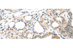 Immunohistochemistry of paraffin-embedded Human thyroid cancer tissue using MASP2 Polyclonal Antibody at dilution 1:35 (MASP2 antibody)