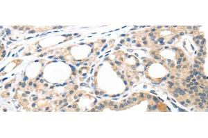 Immunohistochemistry of paraffin-embedded Human thyroid cancer tissue using MASP2 Polyclonal Antibody at dilution 1:35