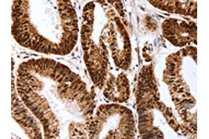 The image on the left is immunohistochemistry of paraffin-embedded Human colon cancer tissue using ABIN7193127(Map2 Antibody) at dilution 1/40, on the right is treated with synthetic peptide.