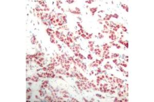 Immunohistochemistry of paraffin-embedded human breast carcinoma using Phospho-NFKB2-S866 antibody (ABIN2988214). (NFKB2 antibody  (pSer866))