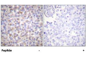 Immunohistochemical analysis of paraffin-embedded human breast carcinoma tissue using YWHAZ polyclonal antibody . (14-3-3 zeta antibody)