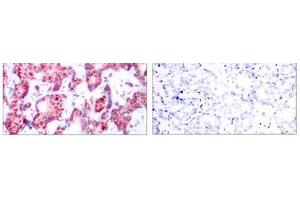 Immunohistochemical analysis of paraffin-embedded human breast carcinoma tissue using GATA-1 (phospho-Ser142) antibody (E011041). (GATA1 antibody  (pSer142))