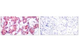 Immunohistochemical analysis of paraffin-embedded human breast carcinoma tissue using GATA-1 (phospho-Ser142) antibody (E011041). (GATA1 antibody  (pSer142))