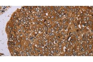 Immunohistochemistry of paraffin-embedded Human esophagus cancer tissue using PIM3 Polyclonal Antibody at dilution 1:35