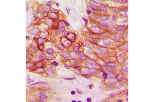 Immunohistochemical analysis of Calmodulin (pT80/S82) staining in human breast cancer formalin fixed paraffin embedded tissue section. (Calmodulin 1 antibody  (pSer80, pSer82))