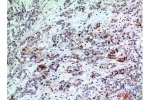 Immunohistochemistry (IHC) analysis of paraffin-embedded Human Breast Cancer, antibody was diluted at 1:200. (BATF3 antibody)