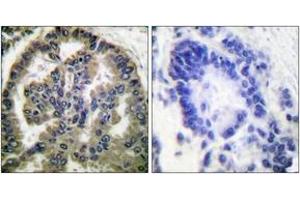 Immunohistochemistry analysis of paraffin-embedded human lung carcinoma tissue, using TGF beta2 Antibody.