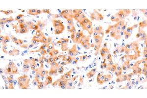 Immunohistochemistry of paraffin-embedded Human liver cancer tissue using Ephrin A1 Polyclonal Antibody at dilution 1:37 (Ephrin A1 antibody)