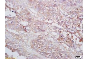 Formalin-fixed and paraffin embedded human lung carcinoma labeled with Rabbit Anti TNMD/tenomodulin Polyclonal Antibody, Unconjugated (ABIN872740) at 1:200 followed by conjugation to the secondary antibody and DAB staining (TNMD antibody  (AA 151-250))