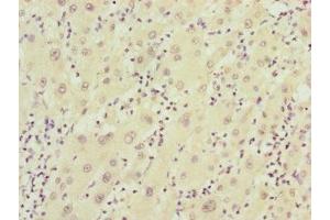 Immunohistochemistry of paraffin-embedded human liver cancer using ABIN7152411 at dilution of 1:100 (FBXO22 antibody  (AA 104-403))