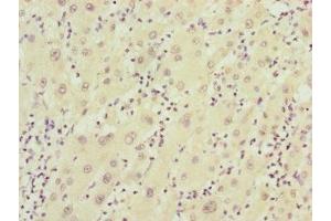 Immunohistochemistry of paraffin-embedded human liver cancer using ABIN7152411 at dilution of 1:100