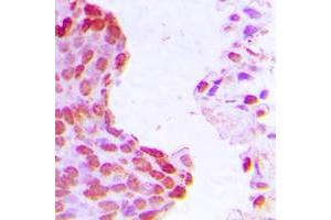 Immunohistochemical analysis of HIF1 beta staining in human breast cancer formalin fixed paraffin embedded tissue section. (ARNT antibody  (N-Term))
