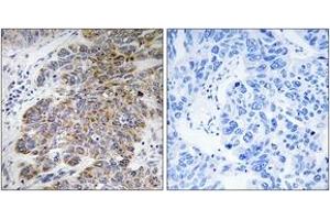 Immunohistochemistry analysis of paraffin-embedded human lung carcinoma tissue, using CHST10 Antibody. (CHST10 antibody  (AA 191-240))