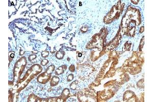 Immunohistochemical staining (Formalin-fixed paraffin-embedded sections) of human lung carcinoma (A), human prostate carcinoma (B), human duodenal carcinoma (C) and human colon carcinoma (D) with TTRAP monoclonal antibody, clone TDP2/1258 .