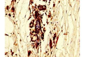 IHC image of ABIN7150454 diluted at 1:300 and staining in paraffin-embedded human breast cancer performed on a Leica BondTM system. (POLR3B antibody  (AA 831-939))