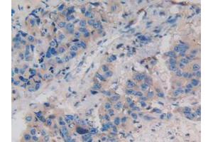 IHC-P analysis of Human Breast Cancer Tissue, with DAB staining. (WNT3A antibody  (AA 19-352))