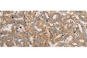Immunohistochemistry of paraffin-embedded Human liver cancer tissue using CEND1 Polyclonal Antibody at dilution of 1:50(x200) (CEND1 antibody)