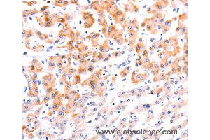 Immunohistochemistry of Human thyroid cancer using EFNA1 Polyclonal Antibody at dilution of 1:37 (Ephrin A1 antibody)