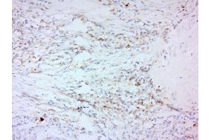 Formalin-fixed and paraffin embedded human laryngeal carcinoma labeled with Anti-MMP-2 Polyclonal Antibody, Unconjugated  at 1:200 followed by conjugation to the secondary antibody and DAB staining. (MMP2 antibody  (AA 561-660))