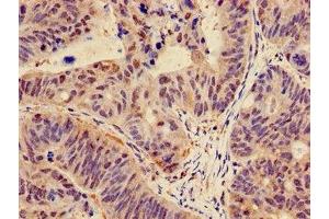 Immunohistochemistry of paraffin-embedded human colon cancer using ABIN7146988 at dilution of 1:100 (CTNND1 antibody  (AA 482-605))