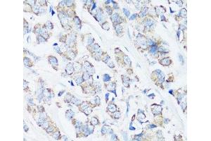 Immunohistochemistry of paraffin-embedded Human breast cancer using SRC Polyclonal Antibody at dilution of 1:100 (40x lens). (Src antibody)