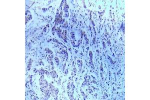 Immunohistochemical analysis of paraffin- embedded human breast carcinoma tissue using ASK1 (Ab-83) Antibody (E022058). (ASK1 antibody)