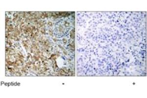 Immunohistochemical analysis of paraffin-embedded human breast carcinoma tissue using IGF1R polyclonal antibody  . (IGF1R antibody)