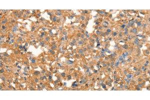 Immunohistochemistry of paraffin-embedded Human thyroid cancer using CRELD1 Polyclonal Antibody at dilution of 1:40 (CRELD1 antibody)