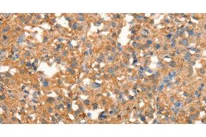 Immunohistochemistry of paraffin-embedded Human thyroid cancer using CRELD1 Polyclonal Antibody at dilution of 1:40 (CRELD1 antibody)