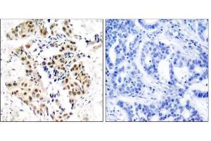 Immunohistochemical analysis of paraffin-embedded human breast carcinoma tissue using ATM (phospho-Ser1981) antibody (E011122). (ATM antibody  (pSer1981))