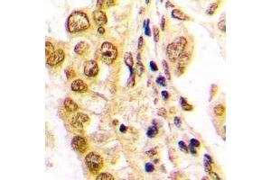 Immunohistochemical analysis of JUND staining in human lung cancer formalin fixed paraffin embedded tissue section. (JunD antibody  (C-Term))